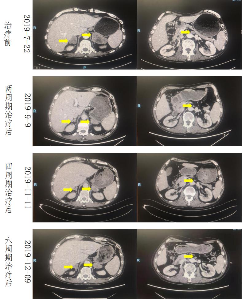 六旬男子小肠癌晚期，经化疗联合免疫治疗后疾病获得长期缓解。免疫治疗或将成为肠癌重要的治疗手段