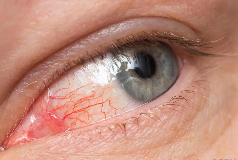 疫情期去不了医院,眼睛红肿频繁眨,可以这么办