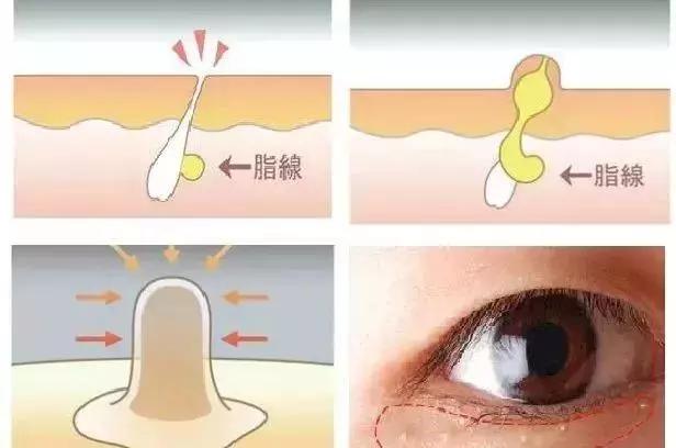 脂肪粒别用针挑教你一个土办法,脂肪粒怎么用针挑出来不疼