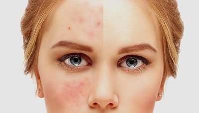 痘痘肌怎么护肤比较好,痘痘肌如何护肤学生