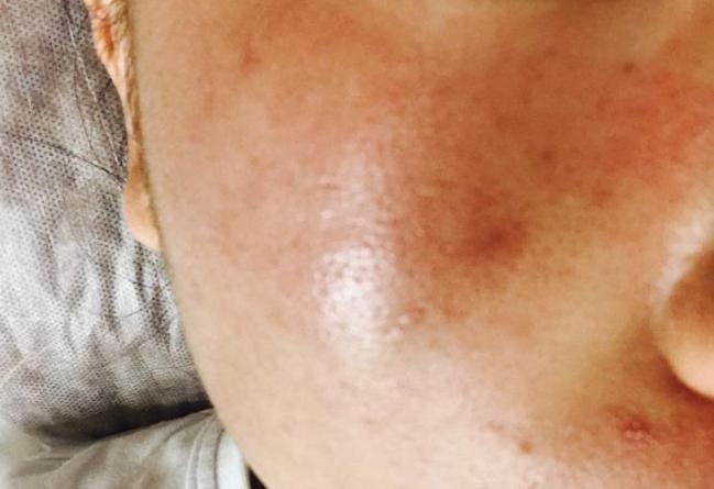 皮肤科脸上长闭口怎么办,皮肤科脸上闭口