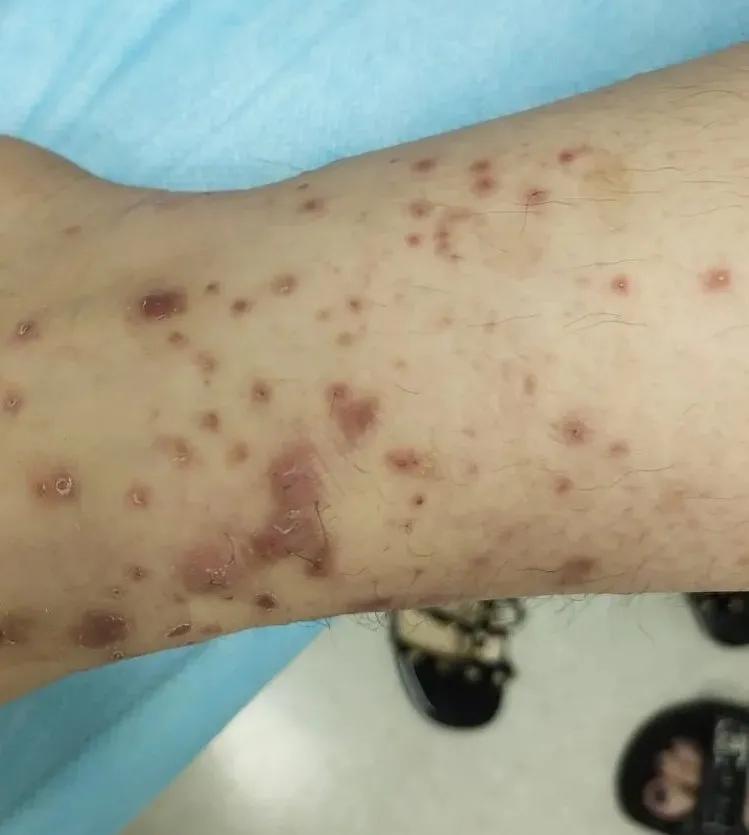 长湿疹就是太“湿”了？华西皮肤科李萌萌：no！越“干”越恼火