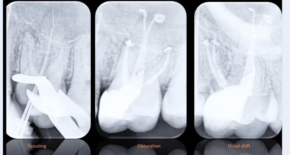 根管锉加工设备,益锐M3根管锉