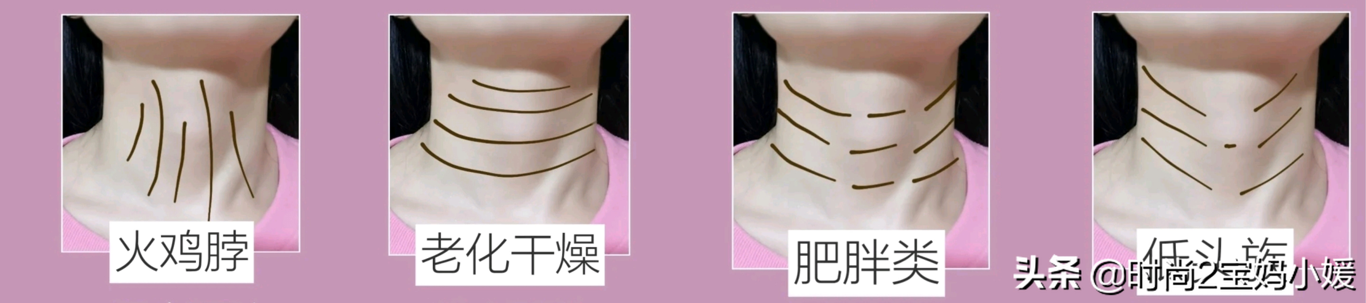 女星脖颈纹怎么处理,女明星脖子的颈纹