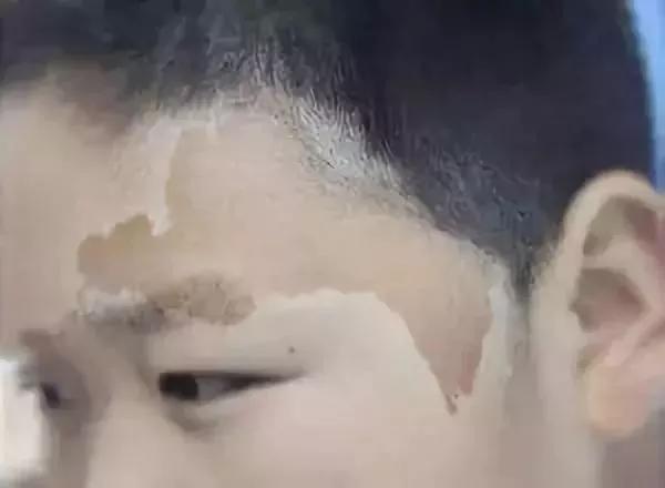 如何区分脸上色斑类型图片,如何辨别面部的各种斑