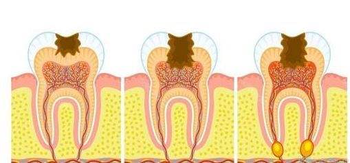 蛀牙会导致细菌感染吗,健康科普挑战赛
