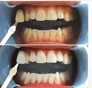 什么是美牙冠矫正,美牙冠对于龅牙效果好么