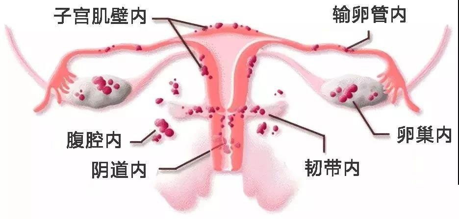 子宫内膜跑了,子宫到处跑是怎么回事