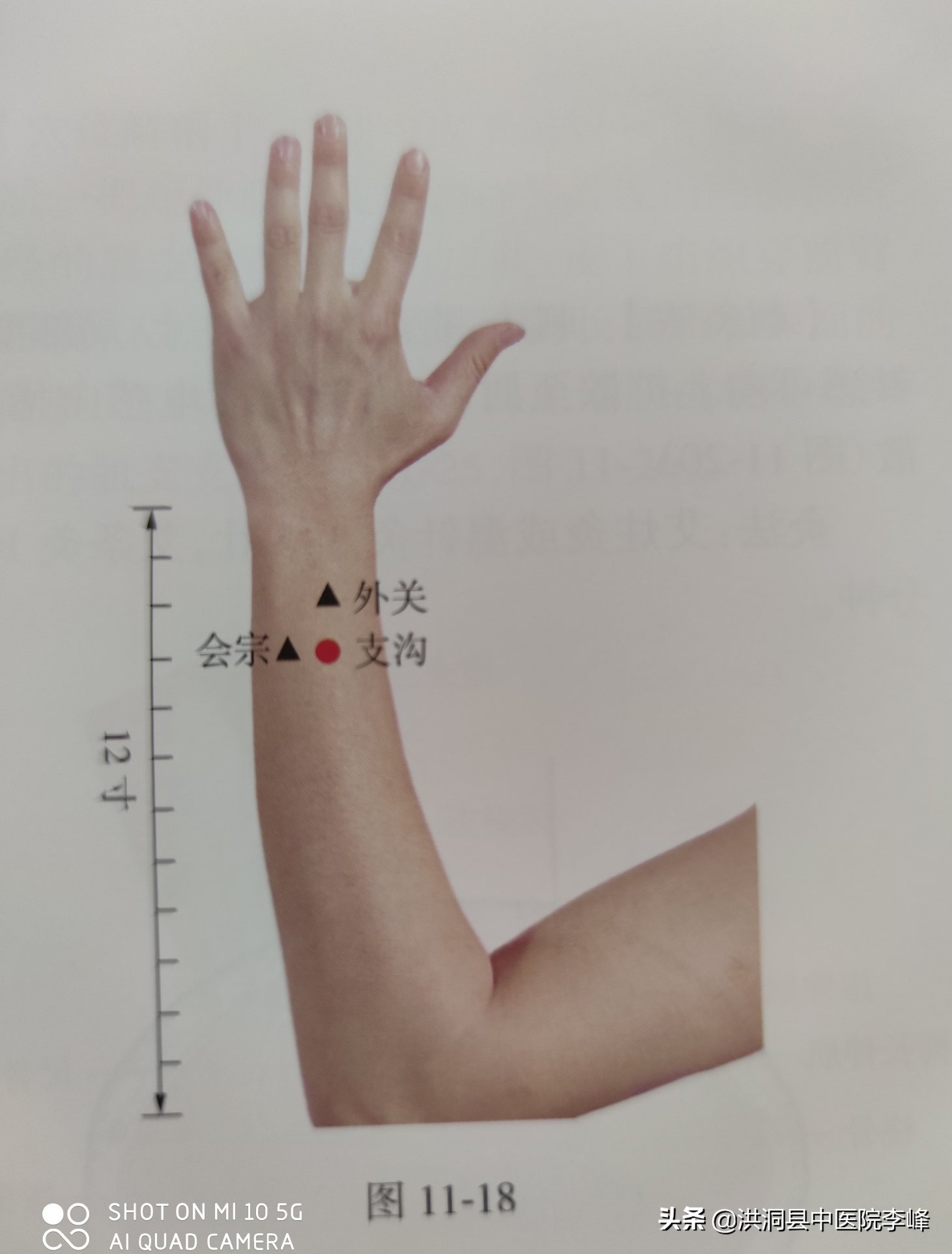 常见痛症“针刺运动疗法”特定取穴