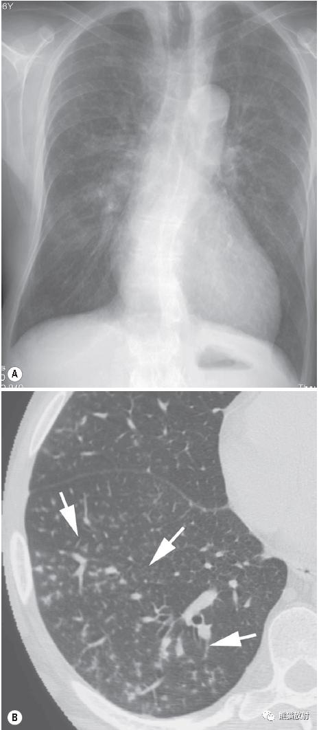 长期卧床病人肺部并发症,卧床患者肺部感染并发症