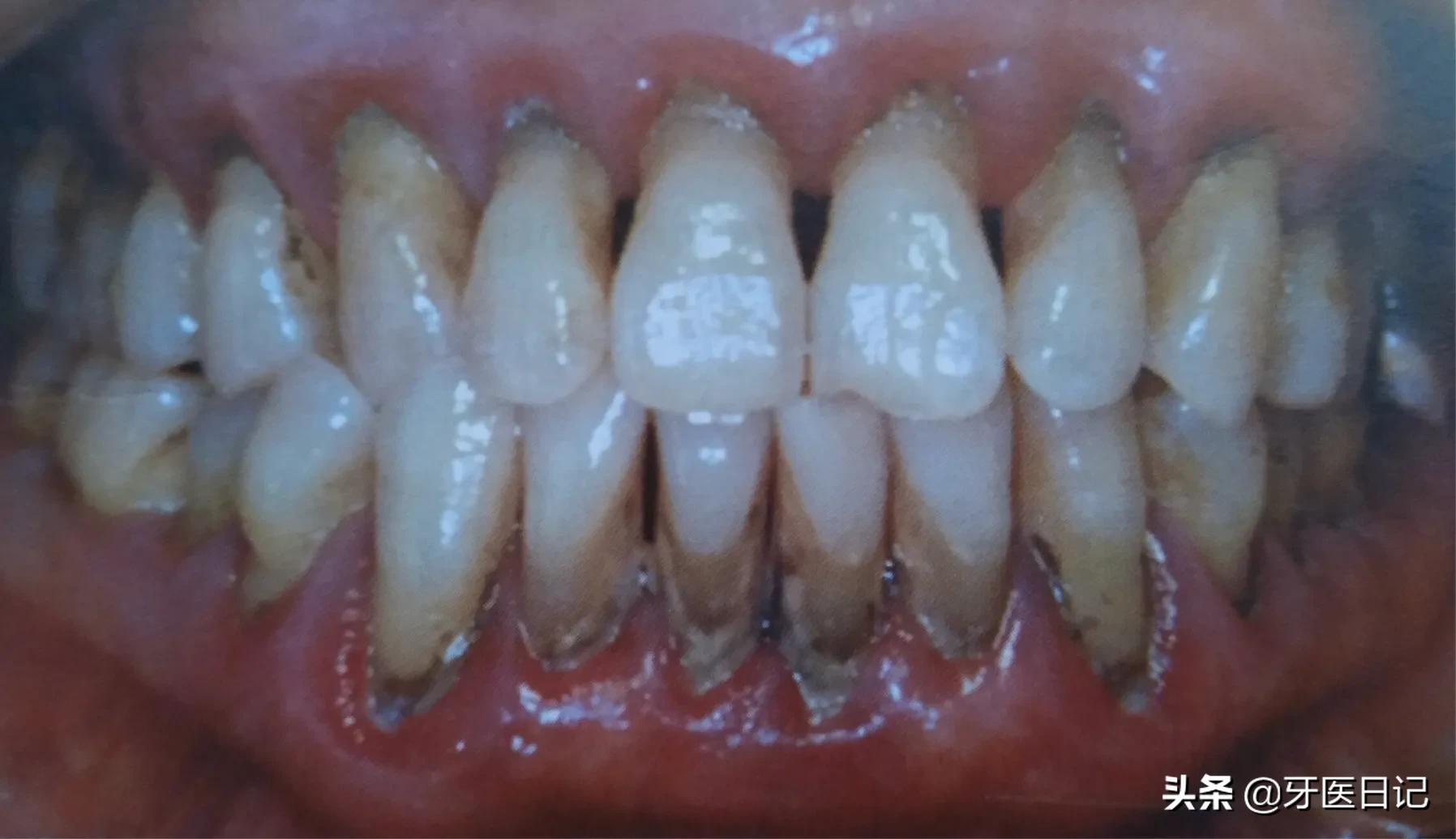 牙龈上火肿了吃什么药,牙龈肿了个肉坨上火疼