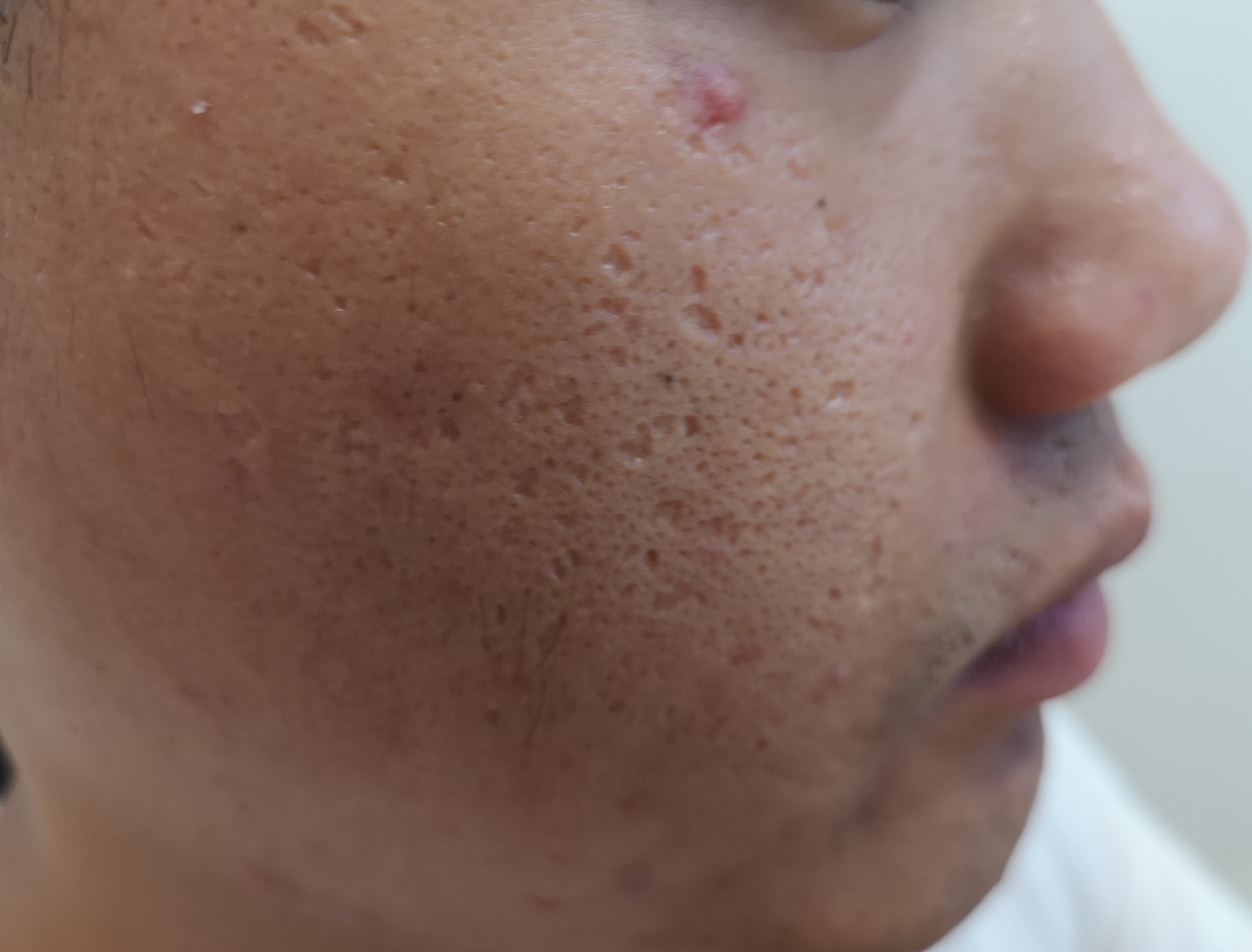 痘痘没了又长怎么解决,痘痘没了毛孔很大怎么办