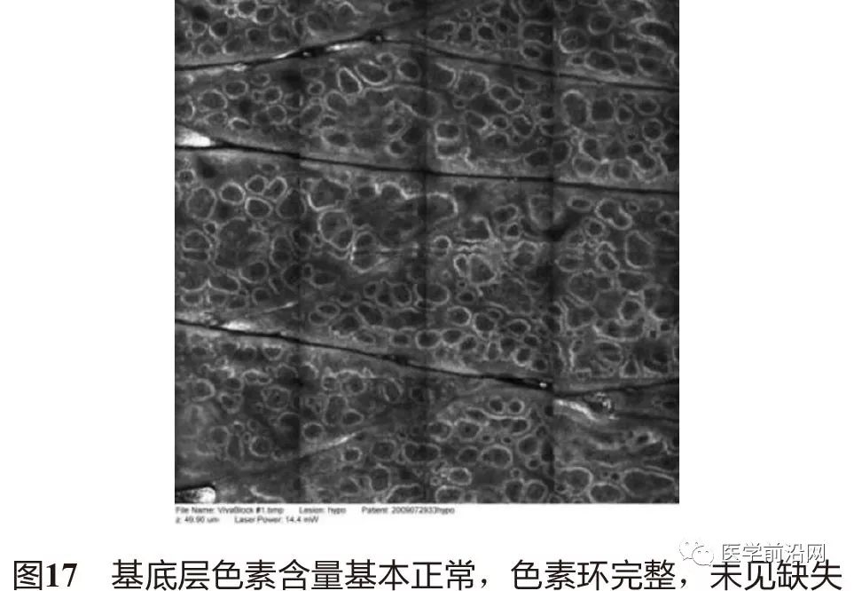 皮肤共聚焦显微镜能查什么,皮肤镜和共聚焦显微镜