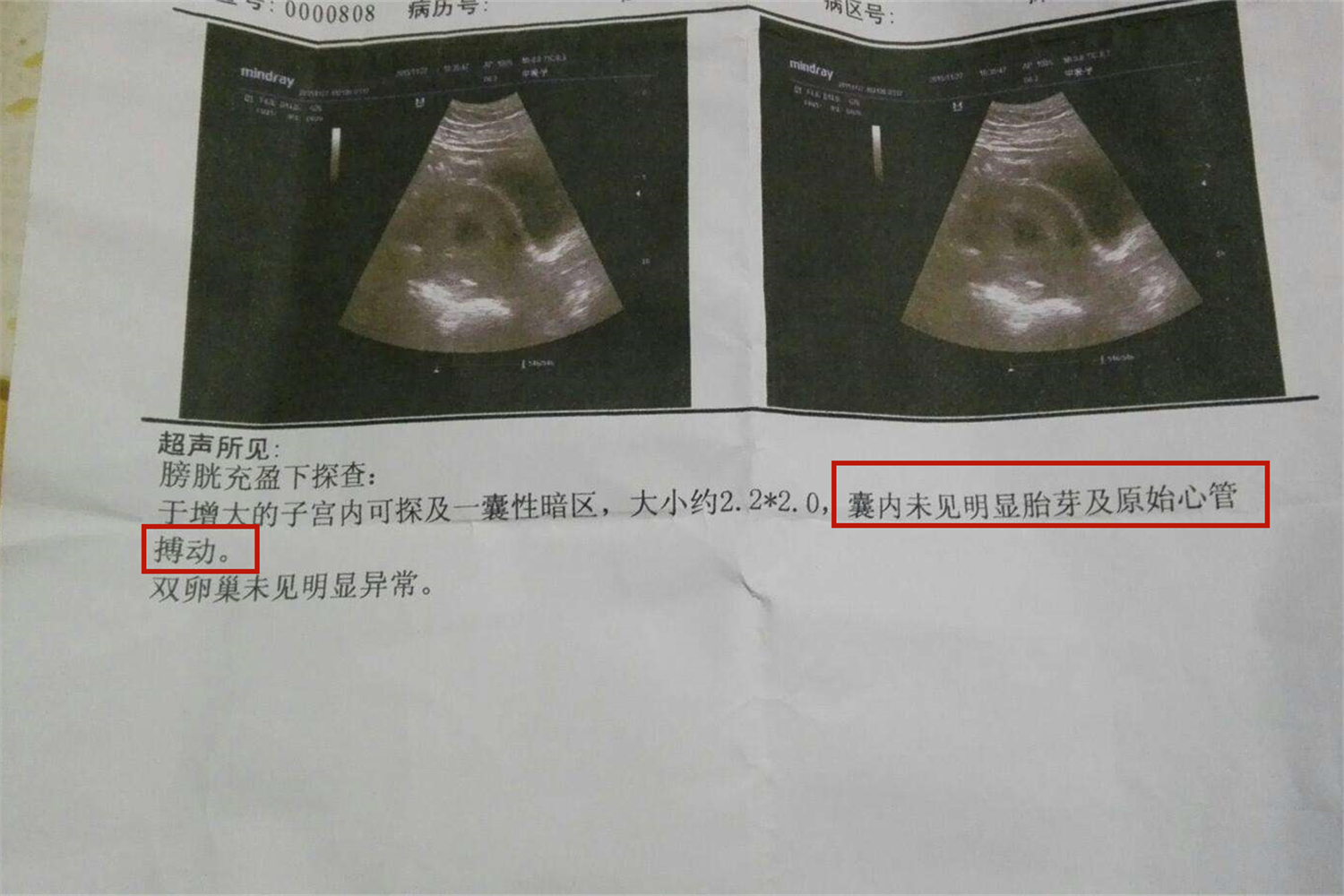 空孕囊孕妇会不会有反应,空孕囊胚胎停育