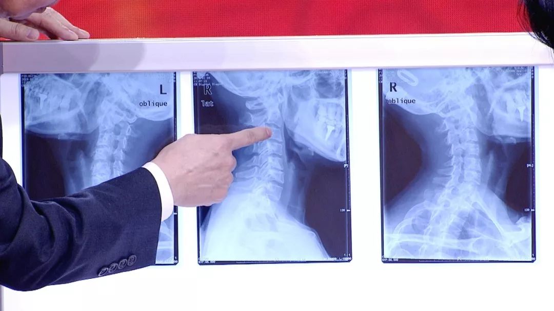 颈动脉有斑块五个办法解决,颈动脉斑块怎么办应该注意什么