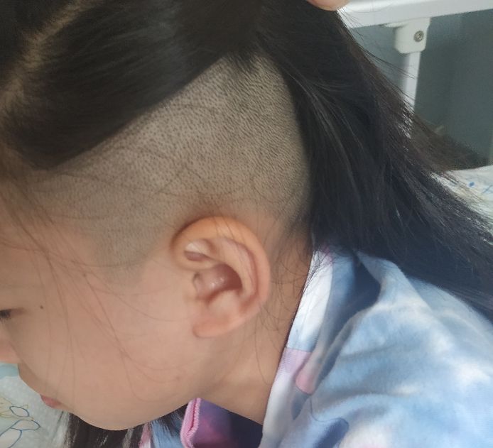 骨髓炎女儿,下颌骨骨髓炎是什么原因引起的