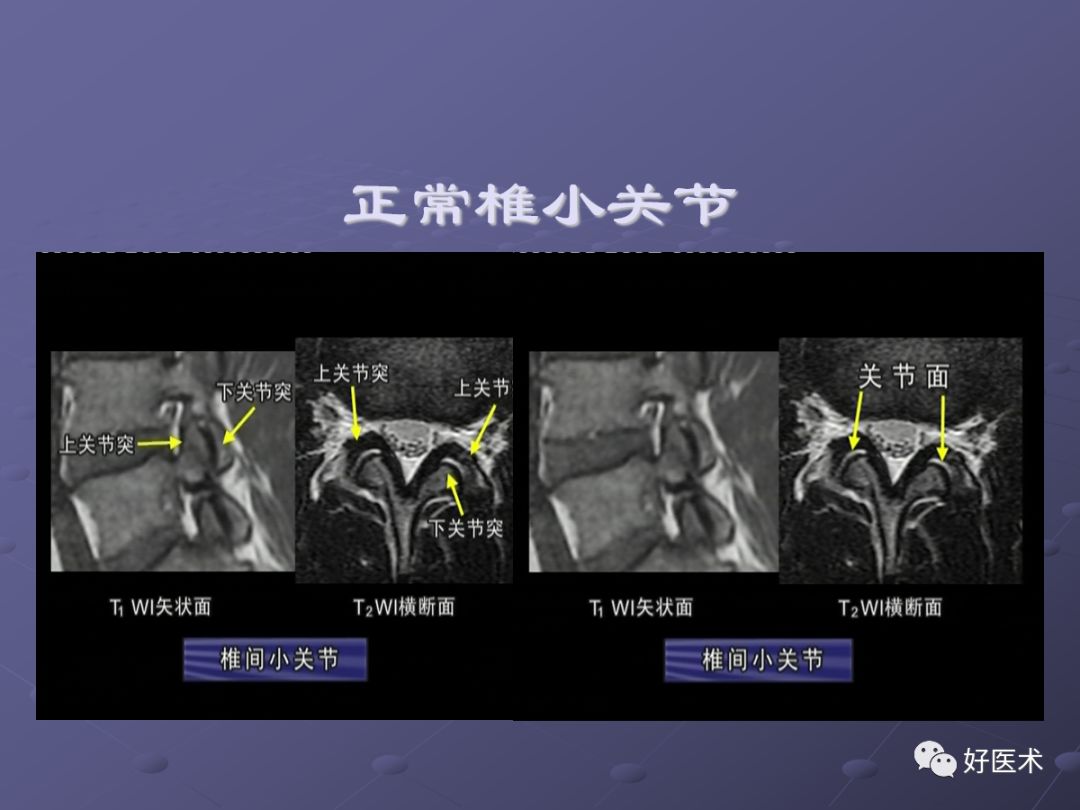 脊柱mri有哪些特点,乳腺疾病的mri诊断及鉴别