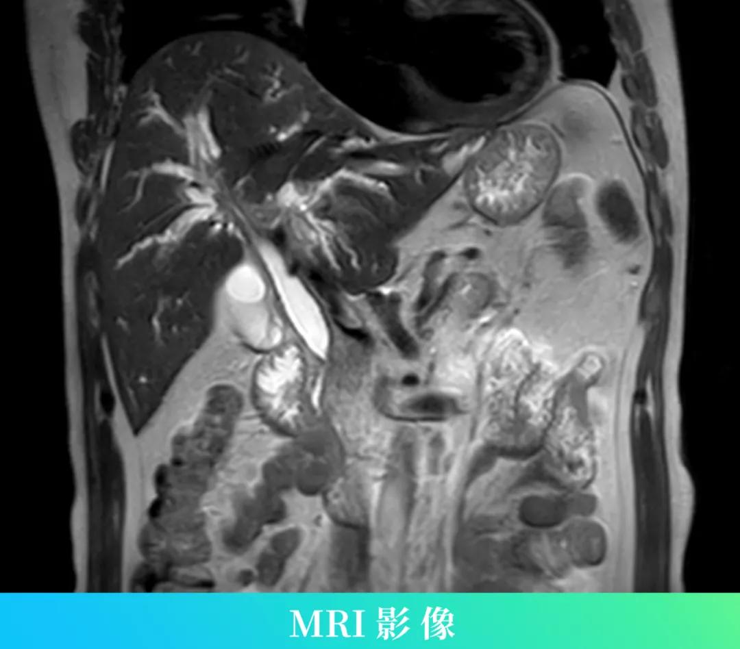 免疫球蛋白g4相关性胆管炎,以为是癌症