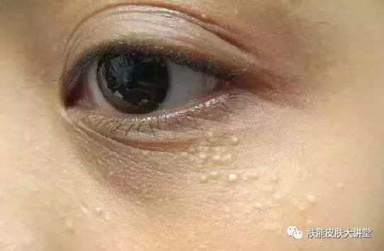 眼睑周围起脂肪粒怎么办,眼睑周围的脂肪粒怎么消除