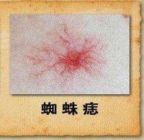 四个征兆暗示你的肝脏好转,这些症状要警惕肝脏病