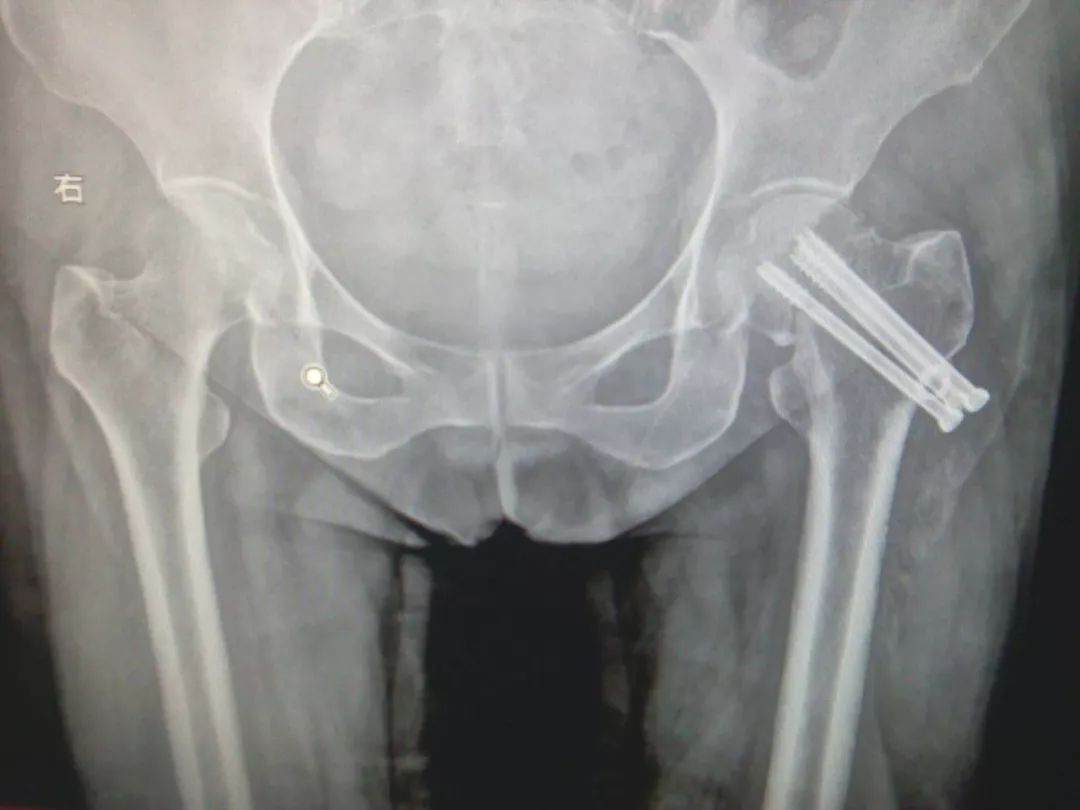 髋部骨折对老年人来说意味着什么,老人髋部骨折多长时间恢复到正常