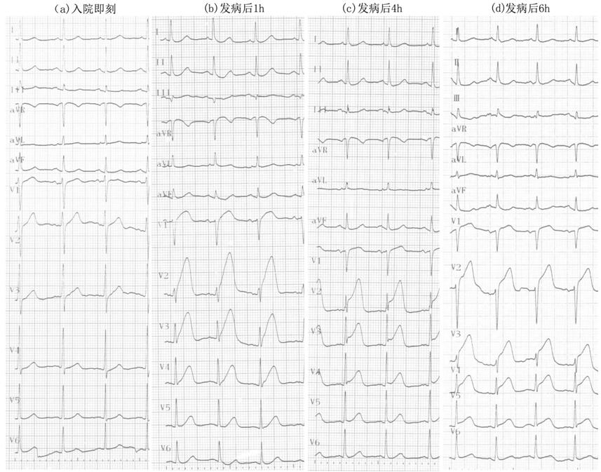 急性心肌梗死的做法,内科主治心肌梗死视频