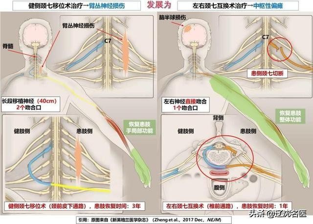 沈阳医大二院手足外科专家,沈阳现代医院治疗偏瘫