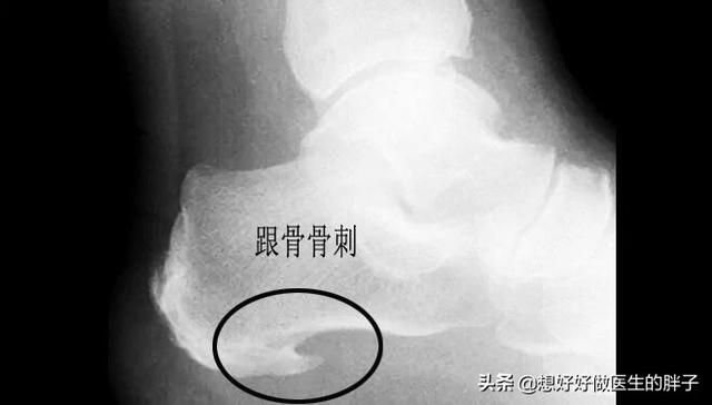 跑步引起脚后跟痛怎么办,跑步引起脚后跟部韧带疼怎么办