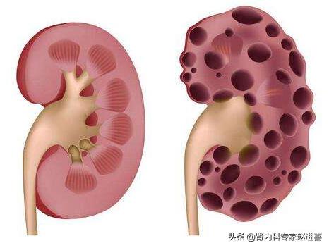 女性双侧多囊肾要注意什么,多囊患者的注意事项有哪些