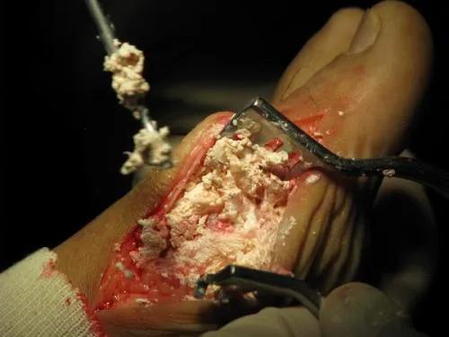 痛风发作可以输液打针缓解疼痛吗,痛风发作时怎么快速缓解疼痛呢