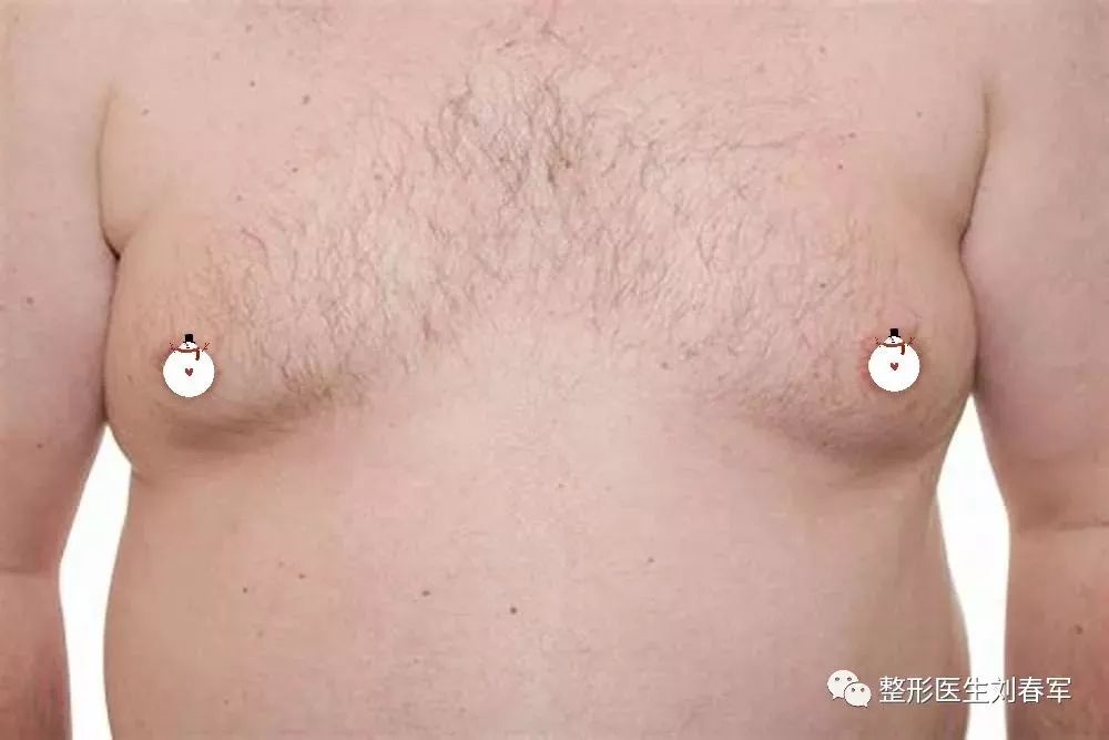 男性胸发育了怎么办,男性胸部发育了怎么办