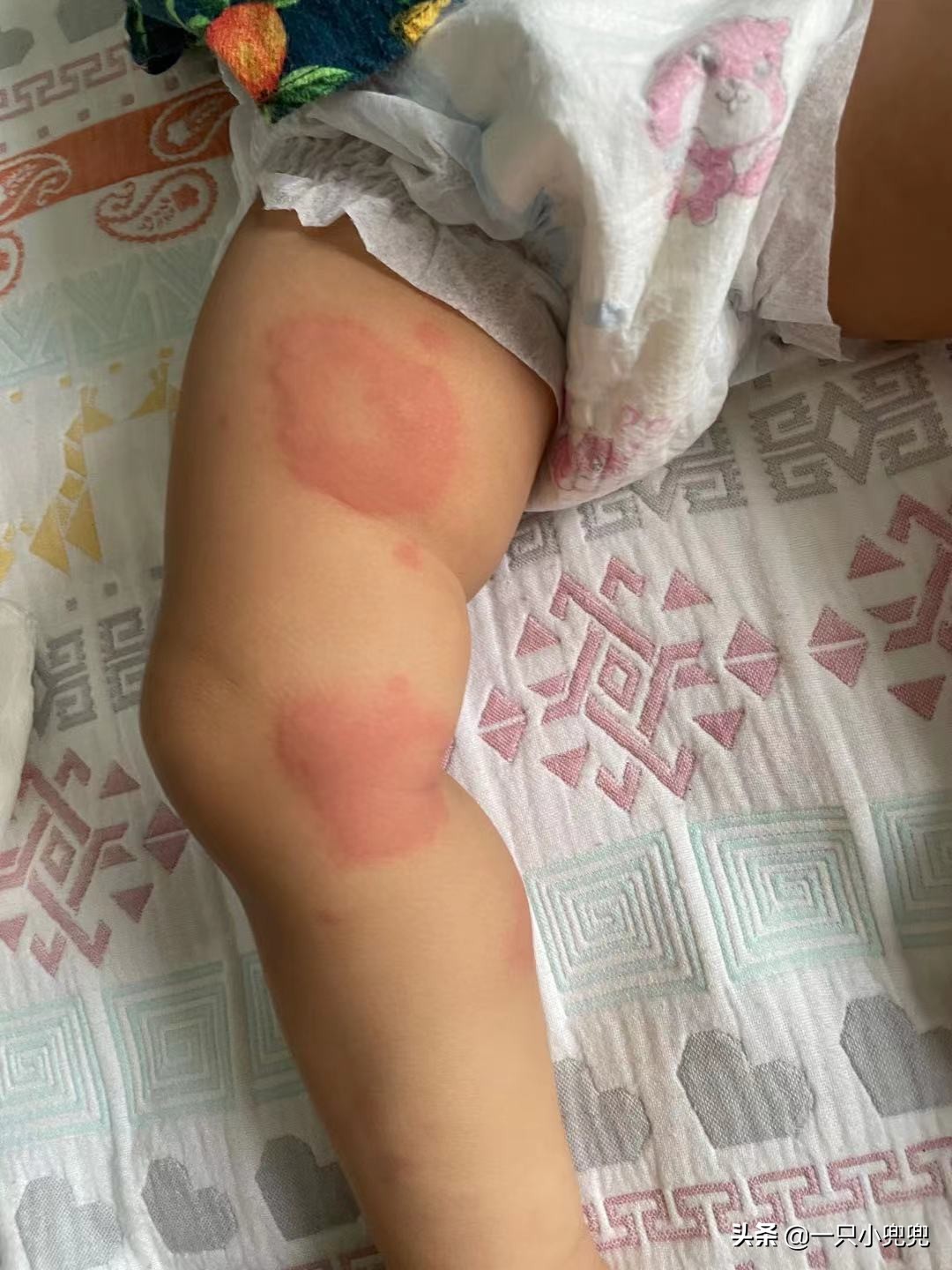 宝宝过敏怎么办六个妙招帮助你,宝宝过敏怎么办看完这篇轻松应对