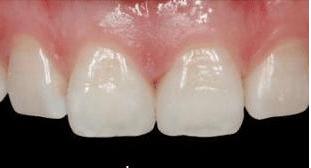 门牙裂了一条缝,门牙有缝的女人