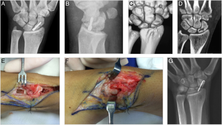 中医治疗腕舟骨骨折,经皮钢板治疗胫骨骨折