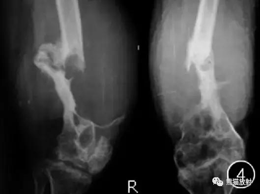 假性血友病什么症状,血友病病理