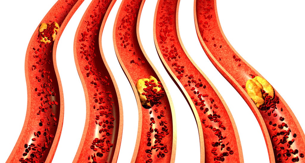 心血管堵塞为什么没有明显症状,如果血管堵塞怎么办