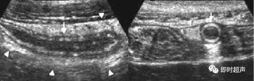 小儿消化道急症超声