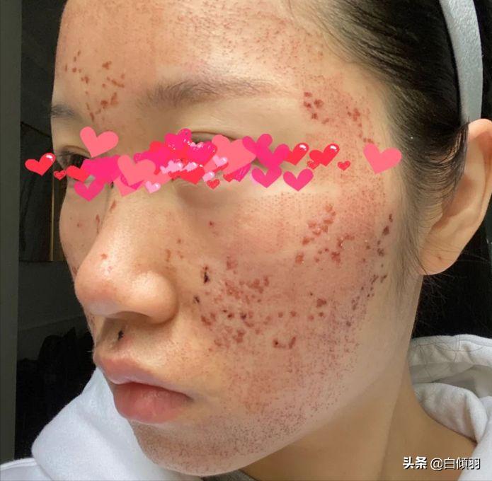 毛孔粗大全搞定这些知识要记牢,毛孔粗大真的能完全改善吗