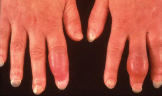 结节病关节痛眼睛模糊,结节病引起的关节炎