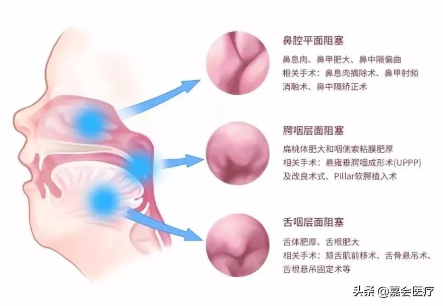 治好打鼾其实很简单的,通过手术能彻底治好打鼾吗