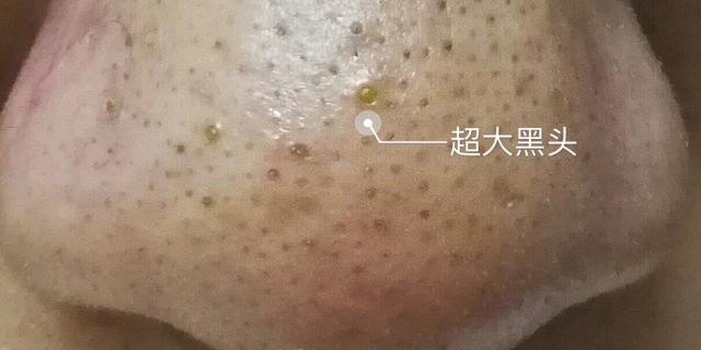 教你怎么去黑头小窍门,最简单的去黑头办法