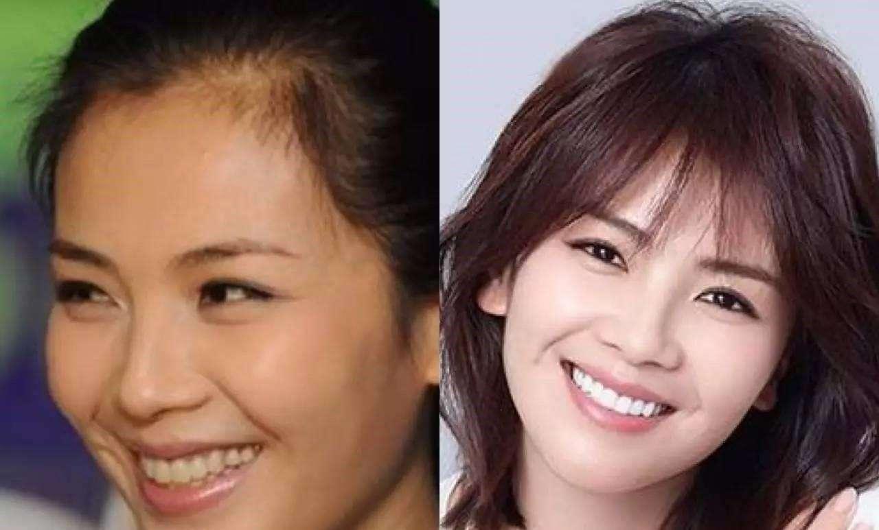 刘涛同款烤瓷牙,刘涛的牙齿烤瓷牙和全瓷牙