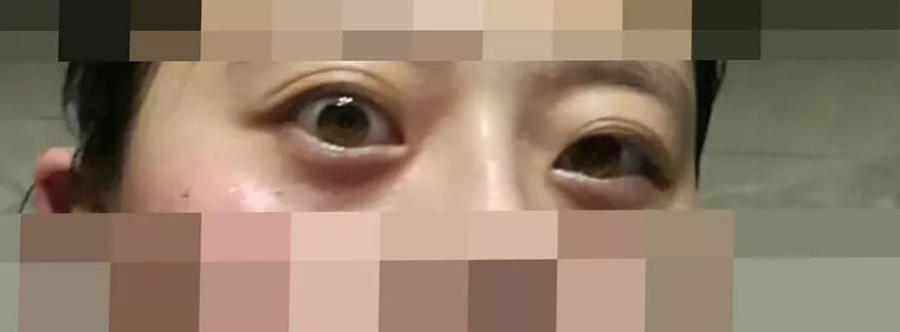 桥本氏甲亢多久转换成甲减,甲亢治疗中为什么会转为甲减