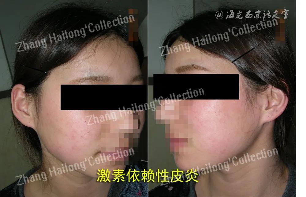 护肤一定要坚持且要有耐心,激素依赖性皮炎怎么护肤