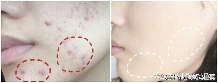 祛痘强效药,超好用的祛痘方法