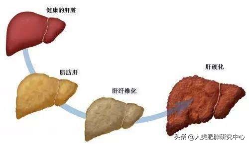 男性肥胖对身体的十大危害,男士腹部肥胖的原因及危害