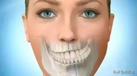 单侧咀嚼毁容,单侧牙齿咀嚼的危害