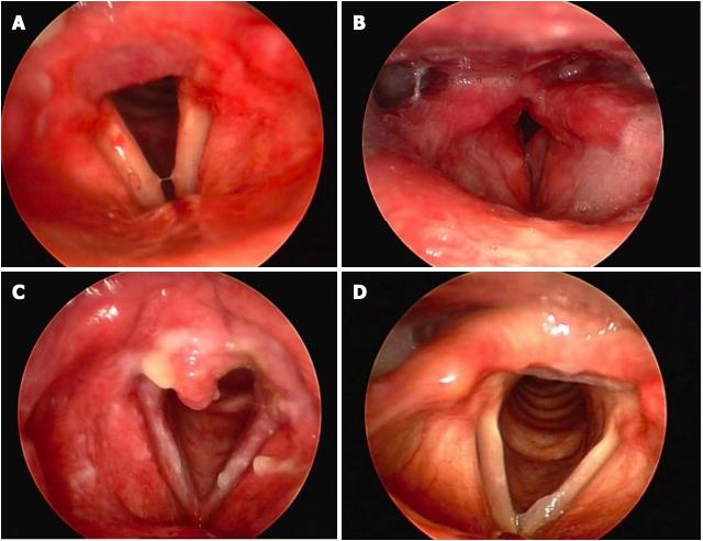 华仔失声遗憾退场——医生：喉炎的原因到底是什么？能不能预防？