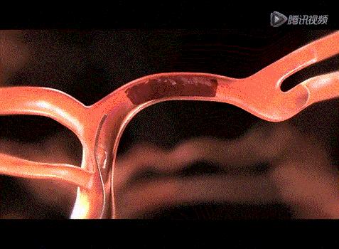 脑血管的清道夫——神奇取栓术