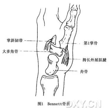 所有骨折都叫什么名字,骨折的名称有哪些